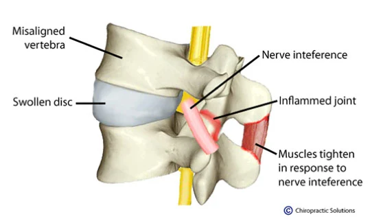 Chiropractic Chandler AZ subluxated spine